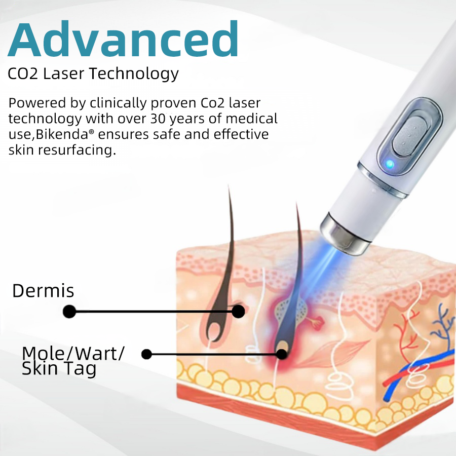 MoleGone® Non-Invasive Mole and Wart Removal Laser Pen Promax