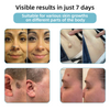 MoleGone® Non-Invasive Mole and Wart Removal Laser Pen Promax