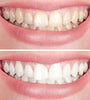Smiley™ - Tooth Whitener | 1+1 Free