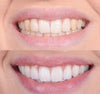 Smiley™ - Tooth Whitener | 1+1 Free