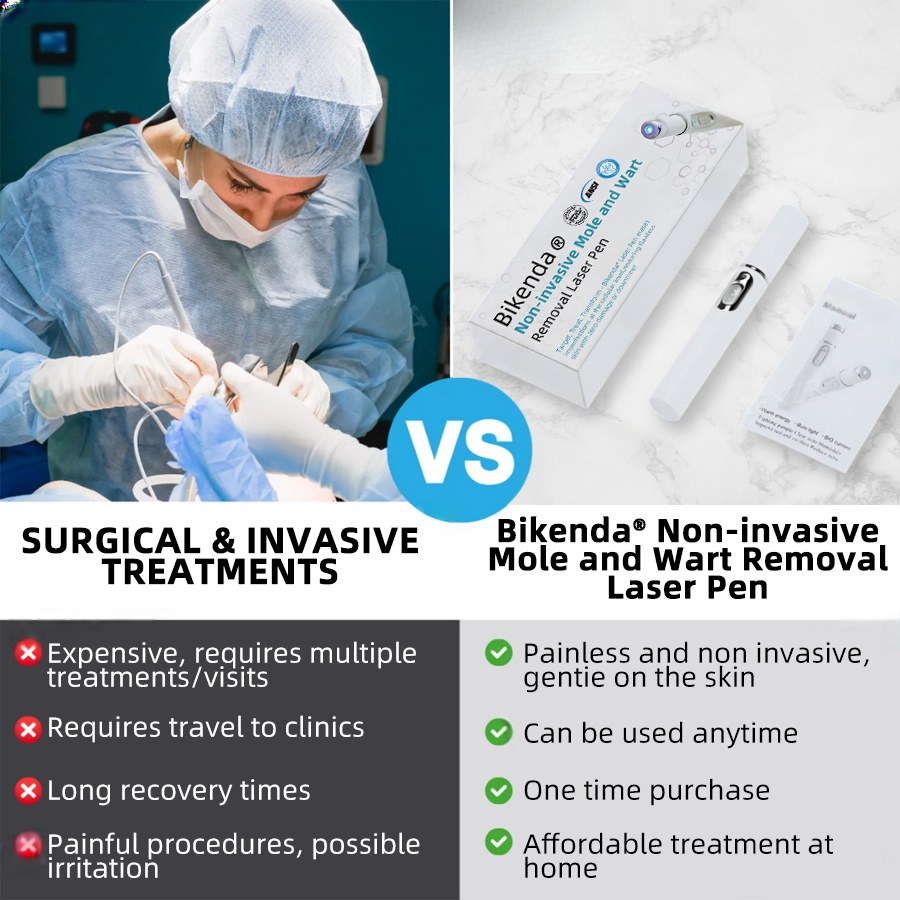 MoleGone® Non-Invasive Mole and Wart Removal Laser Pen Promax