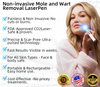 MoleGone® Non-Invasive Mole and Wart Removal Laser Pen Promax