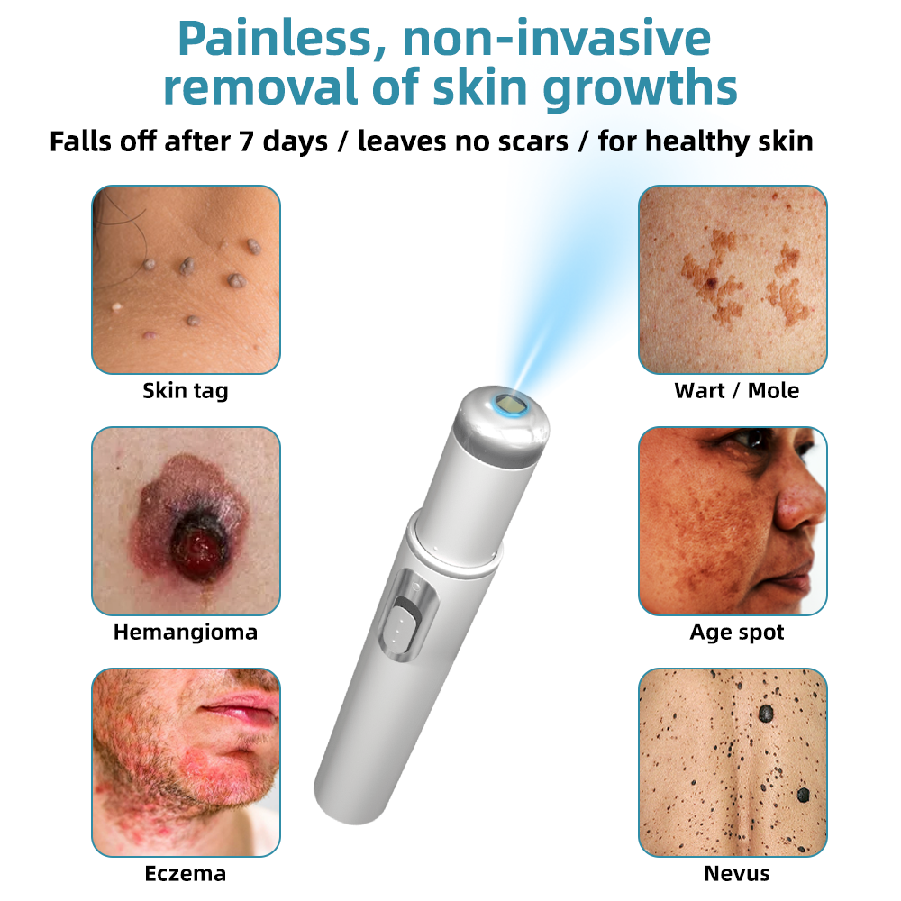 MoleGone® Non-Invasive Mole and Wart Removal Laser Pen Promax