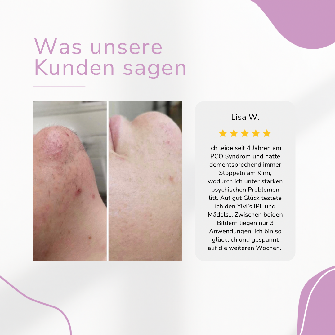 LaserTouch™ – Salon Quality for Your Home Hair Removal