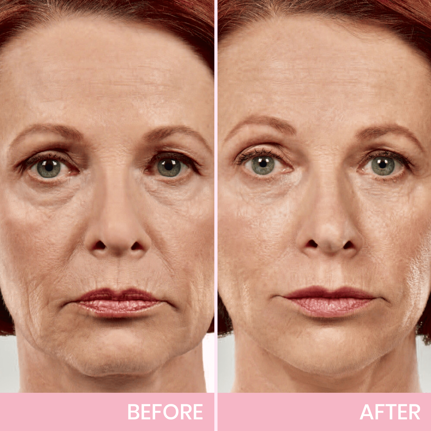OUHOE™ | V-Face Lift Tape | Face Tightening Invisible Tape (40 pieces)