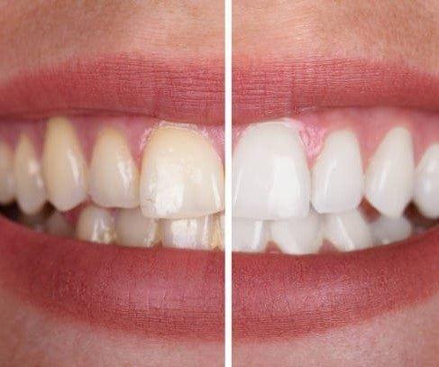 SmileKit™ | Feel More Confident with a Fresh and Radiant Smile That Lasts